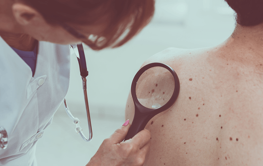 Melanoma decline : We're being more sun-smart and it shows