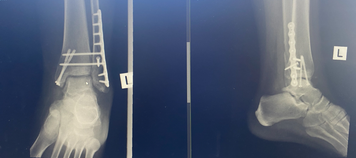 xray_of_2_legs