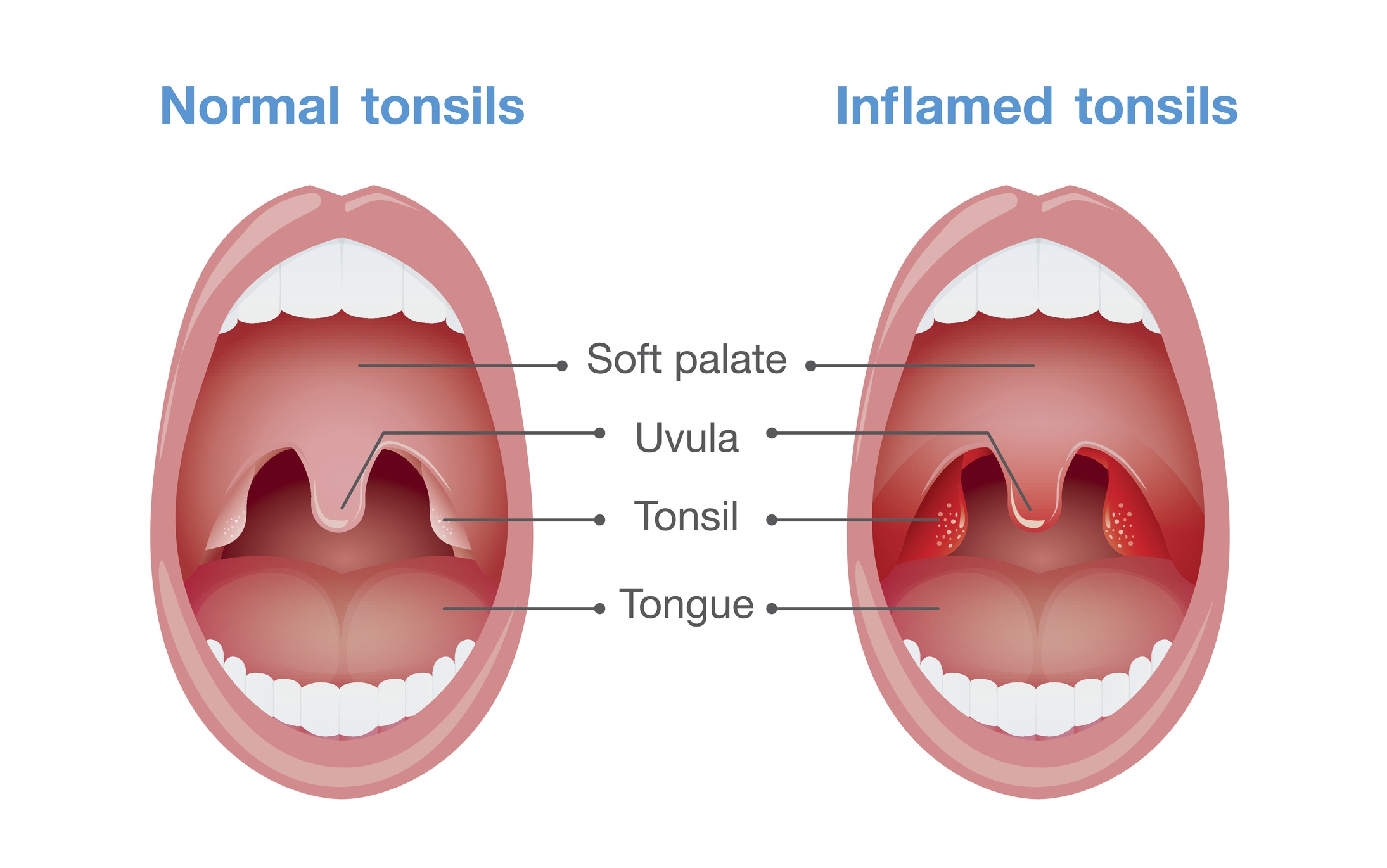 Tonsillitis symptoms