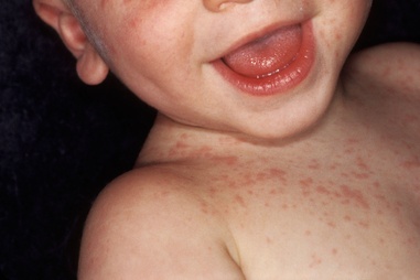 Roseola children health blog